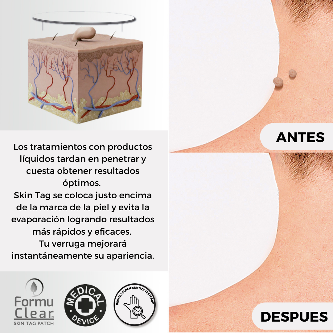 Parches para eliminar verrugas sin dolor