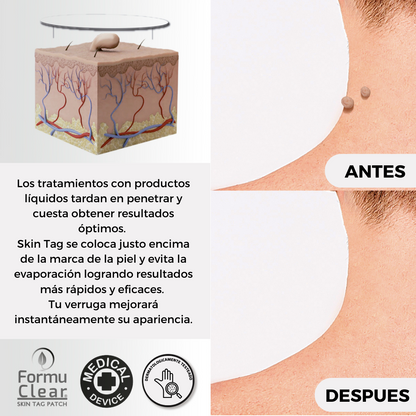 Parches para eliminar verrugas sin dolor